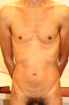 Roseolen en annulaire huidafwijkingen op de romp bij secundaire syfilis