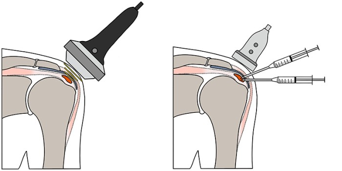 Behandeling met hoogenergetische shockwavetherapie en barbotage