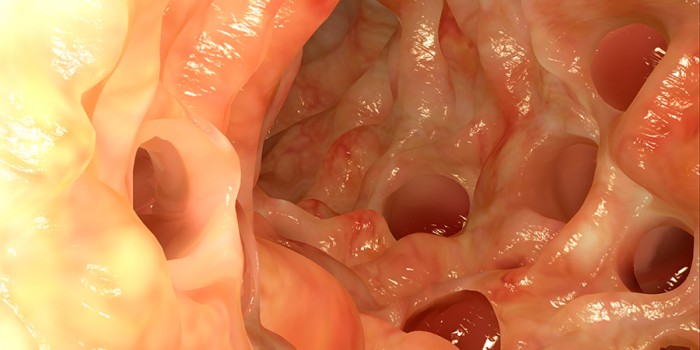 Diverticulitis