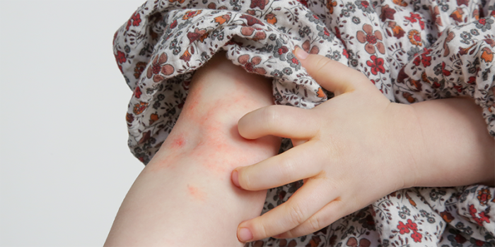 Constitutioneel eczeem