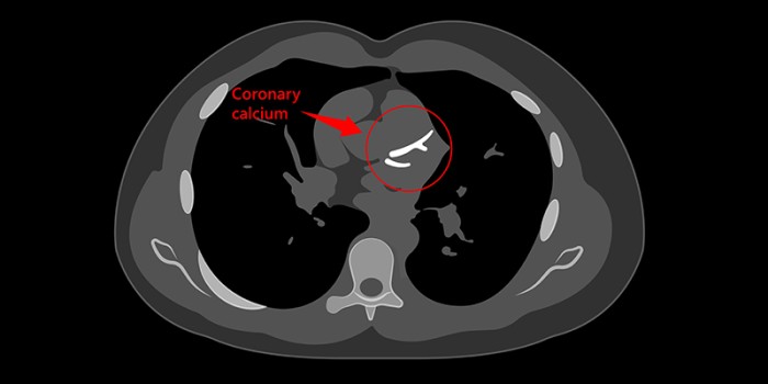 CT-kalkscoremeting