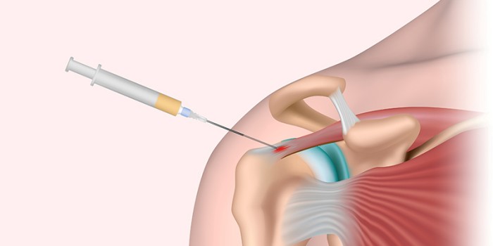 musculoskeletale injecties