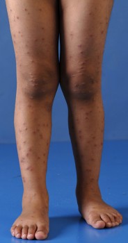 Kinderbenen met daarop rode bultjes