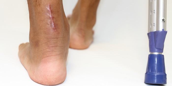 Achillespeesblessure