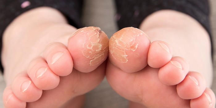 Juveniele plantaire dermatose